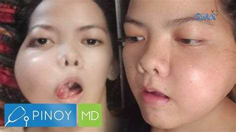 busog na busog sa pag tsupa ng malaking titi si rose|Bukol sa Suso at Mga Uri Nito: Lahat ng Dapat Mong Malaman.